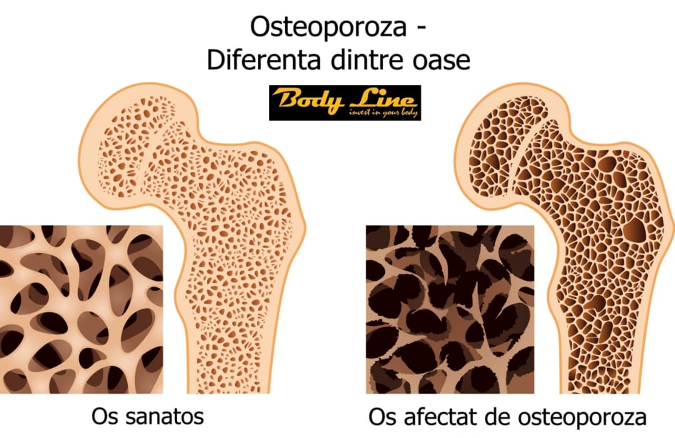 tratament osteoporoza