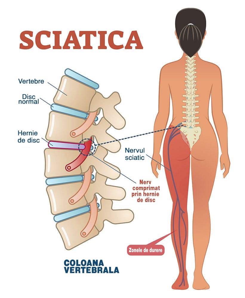 durere arzătoare între omoplați la nivelul coloanei vertebrale durere acută de spate