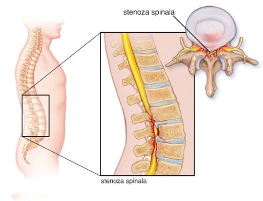 dureri de spate stenoza spinala╠c min 522x400 1