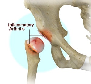 inflamatie artrita